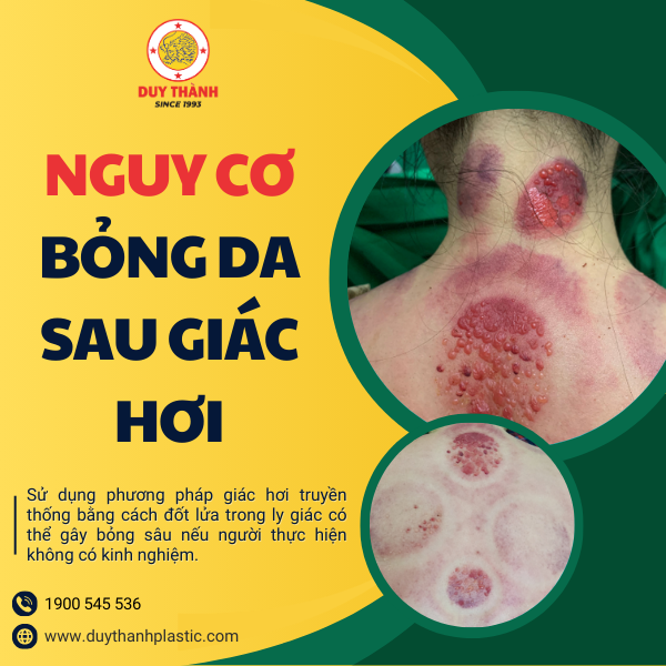 Vết bỏng nghiêm trọng do giác hơi bằng lửa gây ra