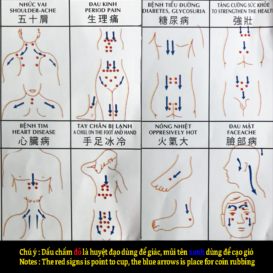 Hướng dẫn đặt ống giác đúng huyệt đạo trong cách dùng giác hơi không dùng lửa