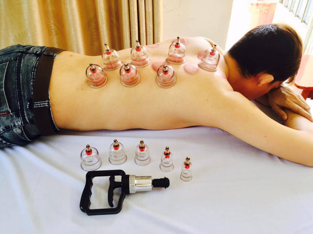 Giác hơi không dùng lửa bằng bộ giác Duy Thành trên lưng giúp lưu thông khí huyết và thư giãn cơ thể