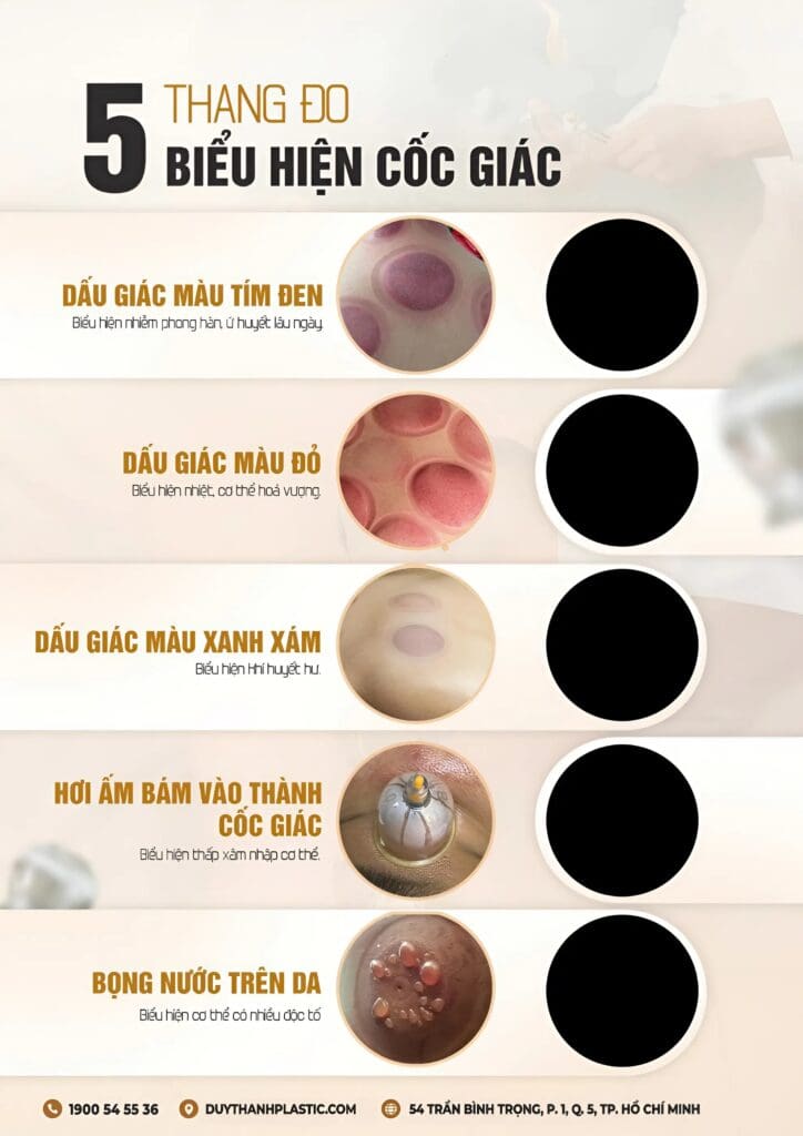 Các màu sắc vết bầm giác hơi và ý nghĩa từng loại theo y học cổ truyền