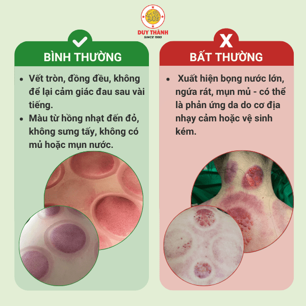Dấu hiệu bất thường của vết bầm giác hơi cần theo dõi y tế